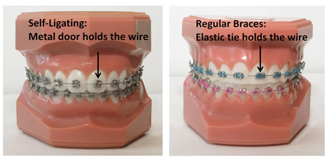 Metal Braces Vs Clear Braces - Scantlebury Orthodontics